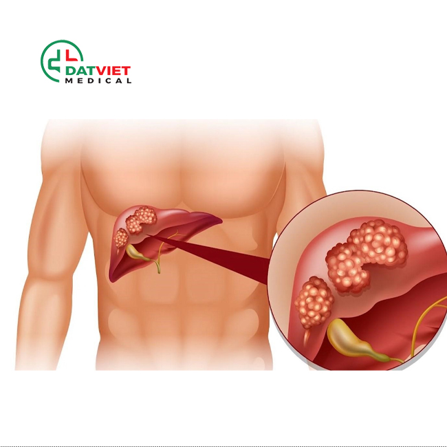 máy xét nghiệm nước tiểu 13 thông số