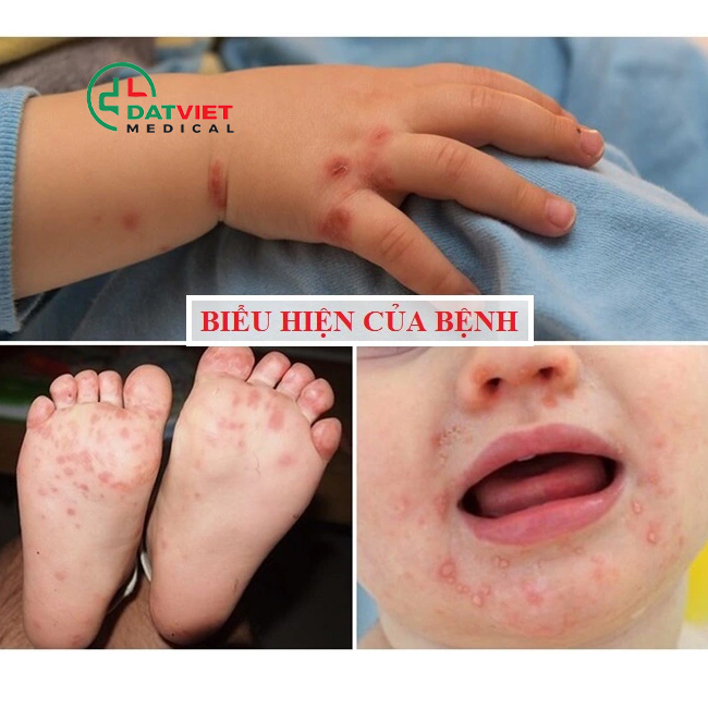 căn bệnh mùa hè thường gặp