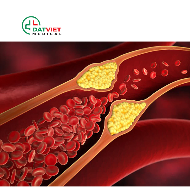 máy xét nghiệm mỡ máu chuẩn hãng