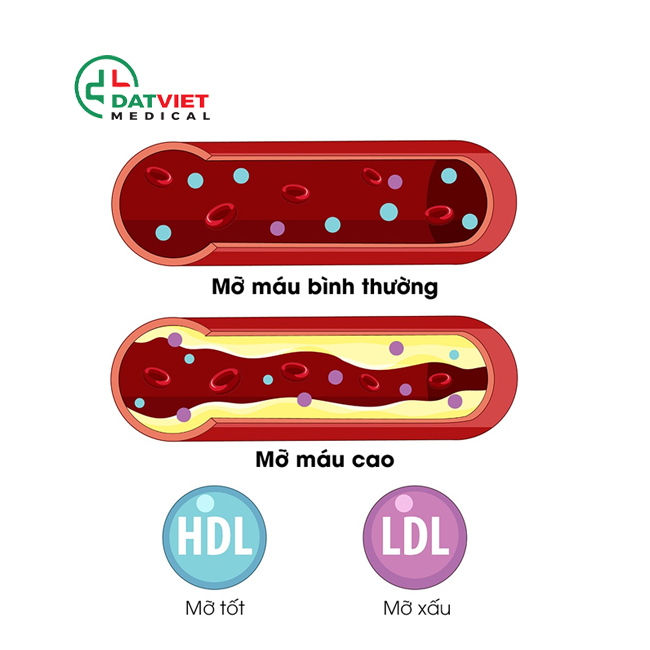 mỡ trong máu có ảnh hưởng gì sức khỏe