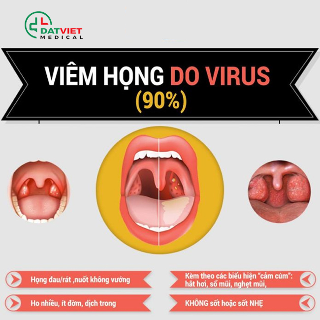 triệu chứng gây bệnh viêm họng là gì