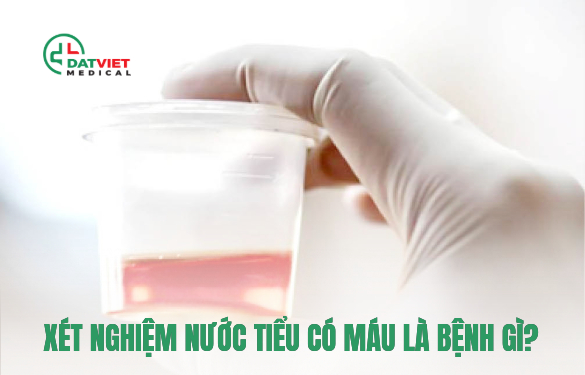 xét nghiệm nước tiểu có máu làm sao