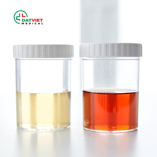 trong nước tiểu có máu là bệnh gì